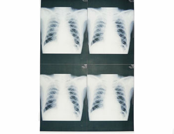 20 सेमी x 25 सेमी मेडिकल डायग्नोस्टिक इमेजिंग, लेजर प्रिंटर फिल्म एक्स रे पेपर